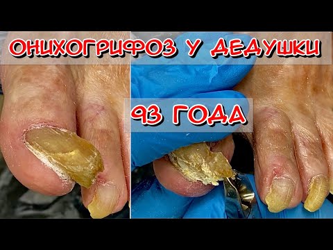 Видео: Онихогрифоз у дедушки / Толстый ноготь / Желтый ноготь / Ноготь растет в бок / Грибок ногтей