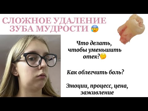 Видео: как прошло мое первое удаление зуба мудрости? Влог 3