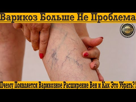 Видео: За ноги больше не стыдно! Почему появляются варикоз и как быстро убрать Вены￼