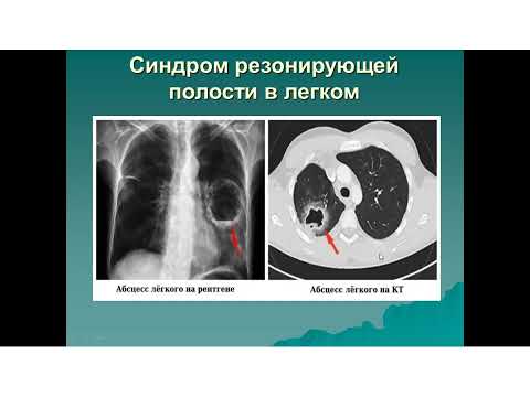 Видео: Основные синдромы пульмонологии.  Часть 1.