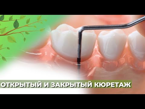 Видео: Открытый и закрытый кюретаж☘️