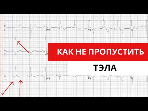 Видео: Как не пропустить тромбоэмболию легочной артерии (ТЭЛА). ЭКГ признаки ТЭЛА.