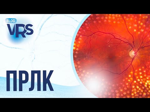 Видео: Сахарный диабет / Диабетическая ретинопатия / Панретинальная лазеркоагуляция