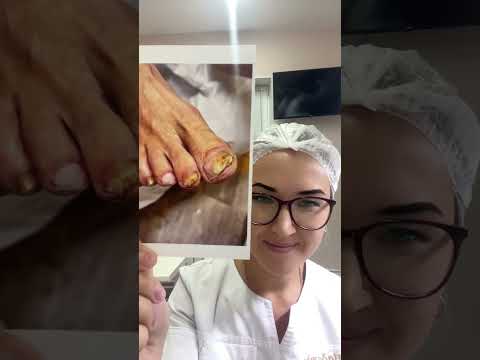 Видео: Онихолизис в кабинете мастера педикюра