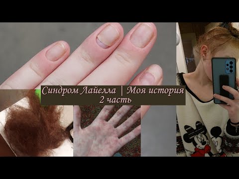 Видео: Синдром Лайелла | Моя история | 2 часть