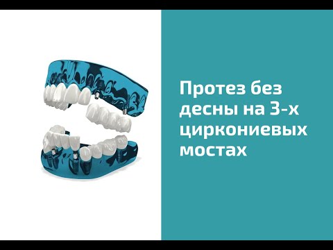 Видео: Протезирование без десны на 3 циркониевых мостах