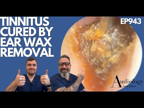 Видео: Лечение шума в ушах путем удаления ушной серы - EP943