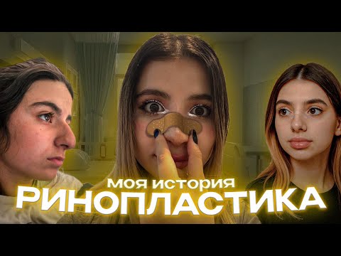 Видео: РИНОПЛАСТИКА | МОЯ ИСТОРИЯ