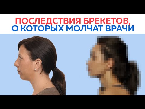 Видео: Брекеты меняют лицо! Правда или нет?! / О чём не говорят врачи - ортодонты?