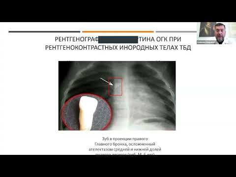 Видео: Инородные тела дыхательных путей у детей