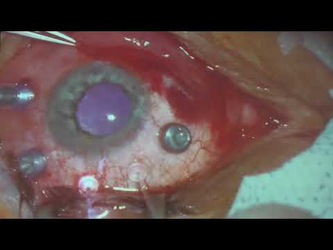 Видео: Оперативное лечение регматогенной отслойки сетчатки
