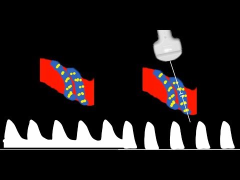 Видео: Интерпретация допплерографии пупочной артерии