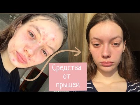 Видео: Лучшие средства от прыщей🦠Как я избавилась от акне| мой уход