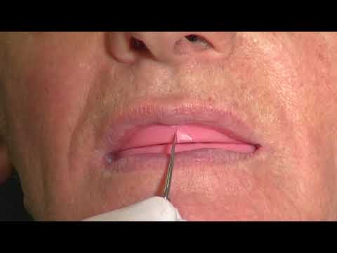 Видео: CRS 10 - набор для регистрации готического угла у беззубых пациентов | Candulor AG (Швейцария)