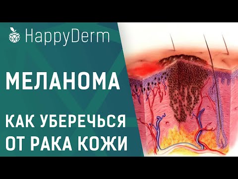 Видео: Меланома кожи - симптомы, диагностика и методы лечения.