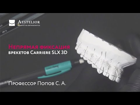 Видео: С. А. Попов: Непрямая фиксация брекетов Carriere SLX 3D на гипсовой модели. Изготовление каппы.