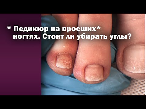 Видео: Макро педикюр на пальчиках 🔝 Вросшие ногти❓ Удаляем подногтевой мозоль🚀