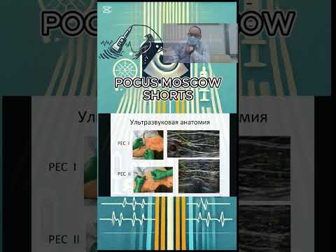 Видео: ПЕКТОРАЛЬНЫЕ БЛОКАДЫ. PEC I & PEC II. RECTUS SHEATH BLOCK. СЕРИЯ РЕГИОНАРНАЯ АНЕСТЕЗИЯ ПОД УЗИ