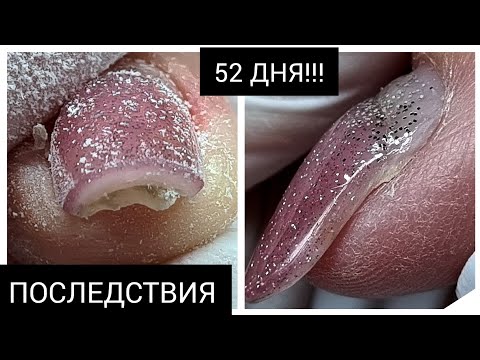 Видео: ПОСЛЕДСТВИЯ длительной носки