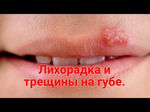 Видео: ПРОСТУДА НА ГУБАХ. Аптечная мазь от лихорадки на губах. От герпеса на губах, трещин и заед.