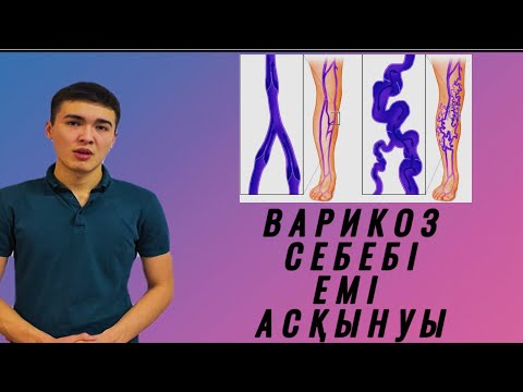 Видео: ВЕНАНЫҢ ВАРИКОЗДЫ КЕҢЕЮІ | СЕБЕБІ | ЕМІ | АСҚЫНУЫ