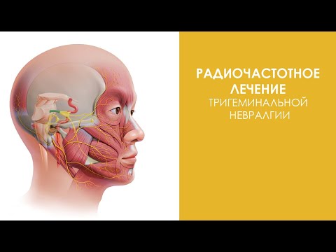 Видео: Радиочастотное лечение тpигeминaльной нeвpaлгии