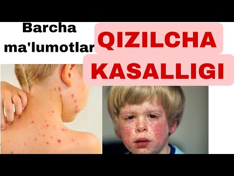 Видео: QIZILCHA KASALLIGI HAQIDA MALUMOT. DAVOLASH VA SABABLARI. КИЗИЛЧА КАСАЛЛИГИ ХАКИДА МАЪЛУМОТ. ДАВОЛАШ