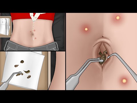Видео: Чистый ли у вас пупок? Анимация ASMR Удаление камня из пупка | Meng's Stop Motion
