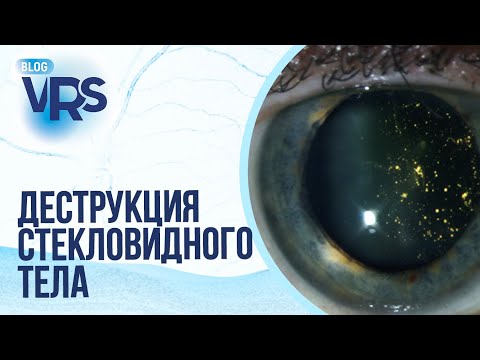 Видео: Деструкция стекловидного тела. Нужно ли оперировать? Мнение иностранных коллег.