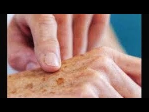 Видео: СТАРЧЕСКАЯ ПИГМЕНТАЦИЯ.Возрастная пигментация. КАК УБРАТЬ ПИГМЕНТАЦИЮ?