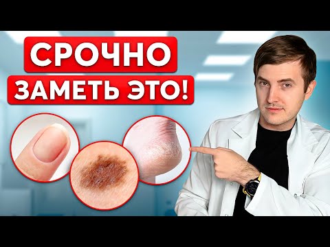 Видео: ТАК НАЧИНАЕТСЯ ДИАБЕТ! Ранние симптомы, которые вы не замечаете...