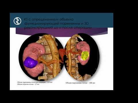 Видео: Лушина П.А.«Оценка паренхимы почки при КТ с перфузией после лапароскопической резекции с гемостазом»