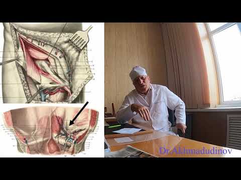 Видео: Топография брюшной стенки. Грыжи. часть 3. Проф. Ахмадудинов М.Г.