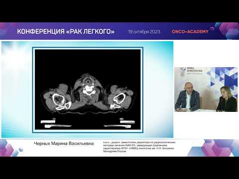 Видео: Химиолучевая терапия  местнораспростр. немелк.рака легкого.  Разбор клинических случаев.Черных М. В.