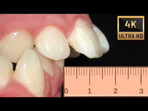 Видео: ✔ Стърчащи 🦷 предразположени към травма❗