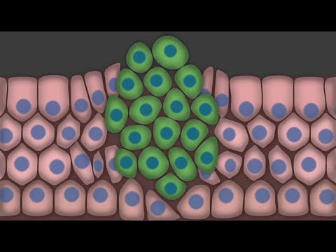 Видео: Что такое рак? Методы диагностики и лечения.