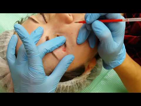 Видео: VIP Advanced Растяжка кожи на модели / Skin stretching on model