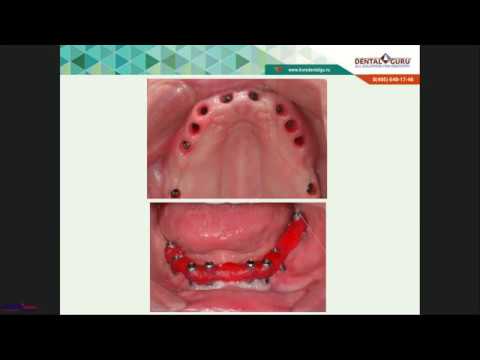 Видео: Вебинар Хабиев К.Н. Одномоментная тотальная имплантация (16.04.2019)