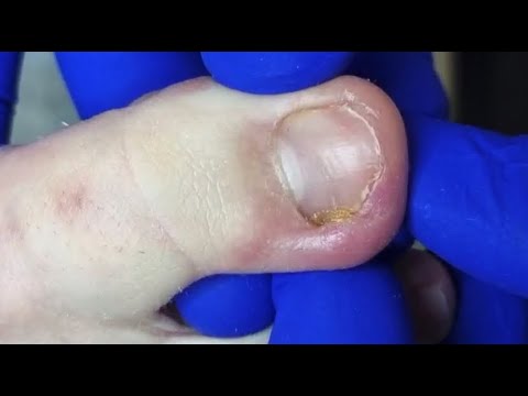 Видео: Вросший ноготь + онихолизис🦶🏻😨🆘⚠️