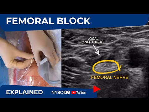 Видео: Блокада бедренного нерва под контролем УЗИ – Экспресс-курс регионарной анестезии с доктором Хаджичем