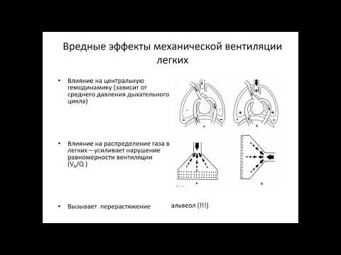 Видео: Искусственная вентиляция лёгких (1 часть)