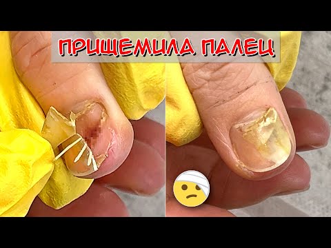 Видео: Прищемила палец дверью / Сошел ноготь на руке, что делать?