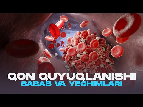 Видео: Қон қуюқланиши сабаблари, уни олдини олиш ва табиий даволаш чора тадбирлари | Доктор Гулбаҳор