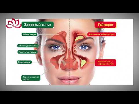 Видео: Терапевтическое лечение гайморита. ЯМИК-катетер.
