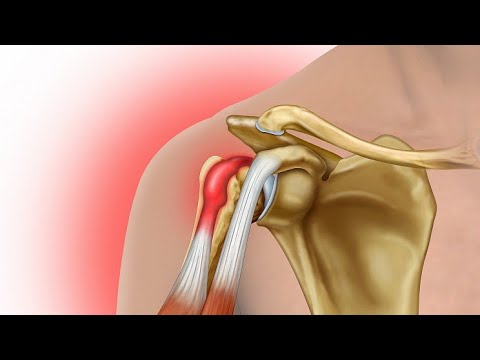 Видео: боль в плече - тендинит длинной головки бицепса (перезапись)