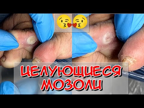 Видео: целующиеся мозоли / мозоль на ноге / мозоль на пальце /