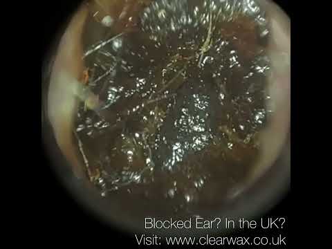 Видео: 338 - Удаление ушной серы у пациента, страдающего рвотным рефлексом, с помощью #WAXscope®️