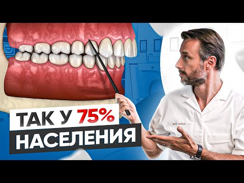 Видео: Самый популярный вид неправильного прикуса у человека #3 | Дистальный прикус