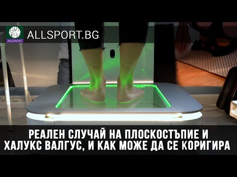 Видео: Реален случай на плоскостъпие и халукс валгус, и как може да се коригира