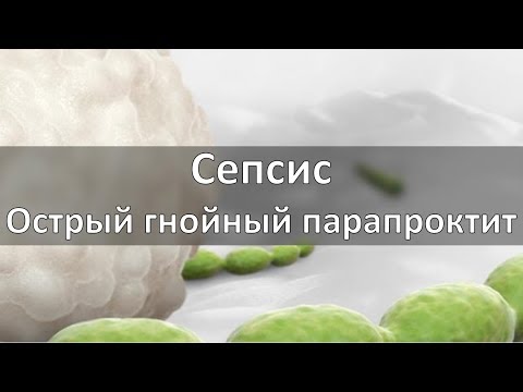 Видео: Сепсис. Острый гнойный парапроктит